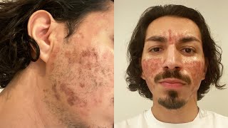 CO2 Laser Treatment for Acne Scars [upl. by Eenat738]