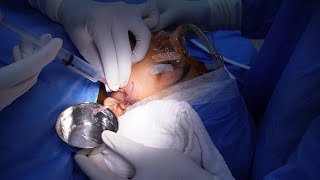 Tmj Arthrocentesis  Joint Pain Relief  Complete Procedure [upl. by Anivlis327]