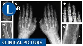 Hyperparathyroidism shows its hand findings of osteitis fibrosa cystica [upl. by Allison]