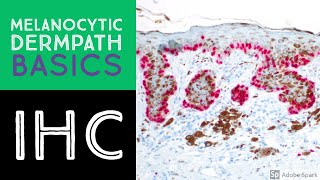 Melanocytic Dermpath Basics Immunohistochemistry [upl. by Anilek788]