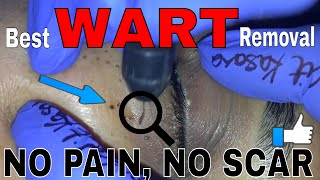 BEST WARTS REMOVAL [upl. by Skerl]