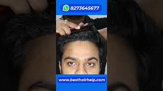 This 6 Months Hair Transplant Result Changed His Life 🔥🔥🔥 hairtransplantresults hairtransplant [upl. by Oniliuqnart]