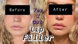 FIRST TIME GETTING LIP FILLER IN LOS ANGELES FULL PROCESS [upl. by Orpheus]