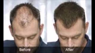 Seborrheic Dermatitis Hair Loss Before And After Seborrheic Dermatitis Hair Loss Before And After [upl. by Otreblaug806]