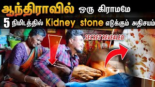 கிட்னி கல் எடுத்தல் இதன் உண்மை வெளியானது  kidney Stone treatment in Tamil  Edison vlogs tamil [upl. by Inad]