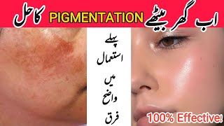 Best Remedy for Hyperpigmentation and Dark Spots  Homemade Pigmentation Solution Treatment Mask [upl. by Hebrew63]