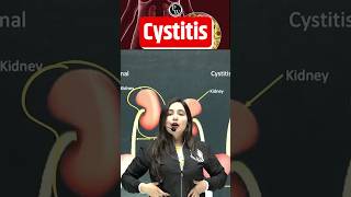 Cystitis Kya Hota Hai   पेशाब की थैली में सूजन  Cystitis ShortsFeed Cystitis Science PW [upl. by Ssyla248]