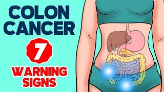 7 Warning Signs of Colon Cancer in 2024 [upl. by Ruperta]