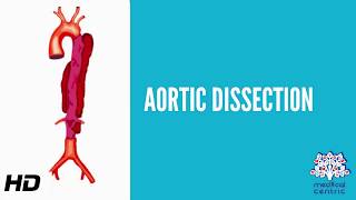 Aortic dissection AD Causes Signs and Symptoms Diagnosis and Treatment [upl. by Wardlaw]