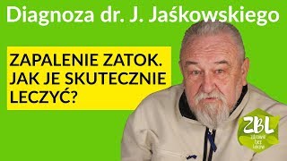 dr Jerzy Jaśkowski  Leczenie zapalenia zatok [upl. by Remo]