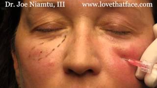 5 minute cheeks by Dr Joe Niamtu III [upl. by Atteuqnas]