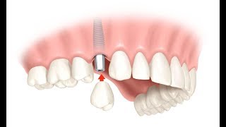 ИМПЛАНТАЦИЯ ЗУБОВ Заключительный этап  УСТАНОВКА КОРОНКИ [upl. by Calvina847]