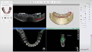 3Shape Implant Studio  Implant Planning [upl. by Africah718]