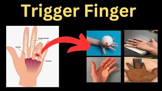 A Complete Guide to Trigger Finger [upl. by Yadahs]