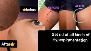 How to get rid of hyperpigmentation at home Diy remedy dark inner thighs pigmented skin wrinkles [upl. by Munroe]