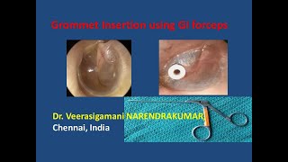 Grommet Insertion using GI Forceps Dr V Narendrakumar [upl. by Otreblanauj]