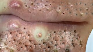 Big Cystic Acne Blackheads Extraction Blackheads amp Milia Whiteheads Removal Pimple Popping  5700 [upl. by Ecirtak]