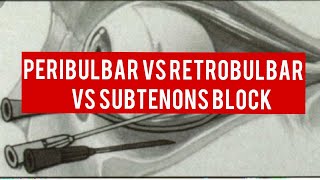 OCULAR ANAESTHESIA  peribulbar block retrobulbar block and subtenons block [upl. by Akino]