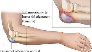 BURSITIS CODO DERRAME ARTICULAR TRATAMIENTO [upl. by Betthel]