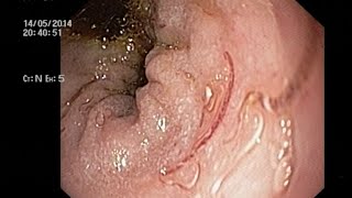 Numerous hookworms in duodenum causing severe anemia with Hb 18 g [upl. by Powers689]