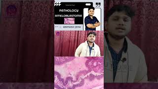 Ameloblastoma  Human Pathology  Full video available in the channel dental [upl. by Nahtam892]