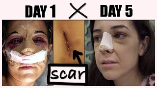 MY REVISION RHINOPLASTY EXPERIENCE IN TURKEY  nose job recovery rib cartilage WEEK 1  Part 3 [upl. by Ishmul]