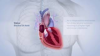 Biotronik pacemaker [upl. by Dorthea]