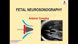 Fetal Neurosonography – Anterior Complex [upl. by Orville]