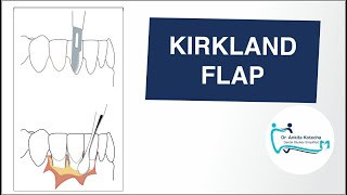 KIRKLAND FLAP ACCESS FLAP MODIFIED FLAP OPERATION PERIODONTAL FLAP SURGERY TECHNIQUEDR ANKITA K [upl. by Reace367]