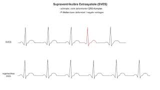 Supraventrikuläre Extrasystole SVES wwwclipdocsde [upl. by Glyn]