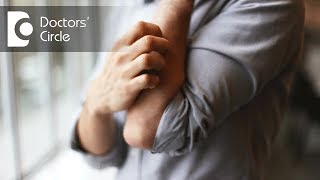 How to manage rashes with severe itching all over the body  Dr Sachith Abraham [upl. by Ehman]