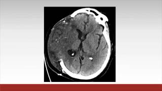 Neurocritical Care Considerations After Cardiac Surgery [upl. by Epilef]