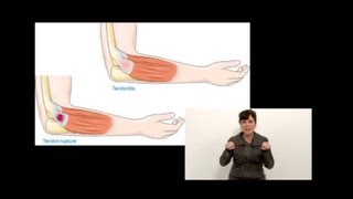 Tendinitis en Músicos ¿Cómo prevenirla [upl. by Silloh]