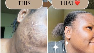 HOW I CLEARED MY HORMONAL ACNE  DARK SPOTS  HYPERPIGMENTATION FOR GOOD IN 1 MONTH skincare art [upl. by Robert130]