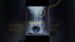 Staghorn Calculus Removed through Single Track and Tubeless  PCNLurologist yavatmal kidneystone [upl. by Niawat]