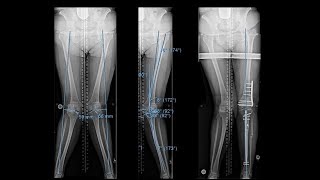 Surgical Realignment Knock Knee Correction [upl. by Siramed]