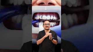 Office bleach for teeth whitening suratdentist dentist smiledentist [upl. by Nirad85]