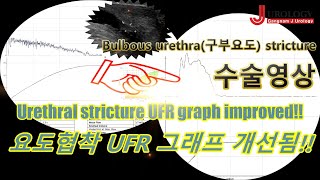 홀뮴레이저를 이용한 구부요도협착 수술로 요속그래프 개선되었습니다 Holmium laser bulbourethral surgery improved UFR graph [upl. by Cerf]