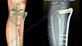 External Fixation With Locking Plate  Everything You Need To Know  Dr Nabil Ebraheim [upl. by Anavlys]