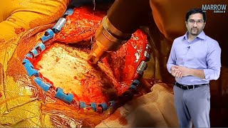 E6 Sample Video Epidural amp Subdural Hematoma Surgery [upl. by Enaols455]