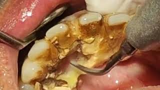 How to remove TARTAR from Teeth  Tartar removal before and after [upl. by Nifares187]