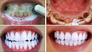 Remove Black Stains on Teeth at Home in 3 Minutes  Natural Teeth Whitening Method [upl. by Anayek]