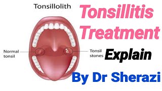 Homeopathic medicine for tonsils Tonsicare homeopathic medicine full explain in hindi urdu [upl. by Euginom]