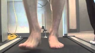 Arthritis big toe Video Gait Analysis Orthotics heel pain Mississauga Brantford Podiatry Chiropody [upl. by Ydnew]