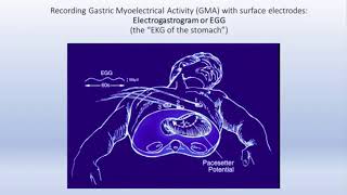 Gastroparesis Review and Update by Kenneth Koch MD [upl. by Anehsak433]