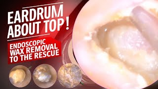 Eardrum About to Pop Endoscopic Wax Removal to the Rescue [upl. by Finnegan]