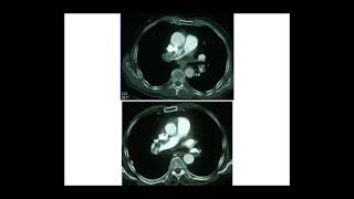 EMBOLIE PULMONAIRE Pr M METAHRI [upl. by Nidnarb61]