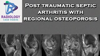 Post traumatic septic arthritis with regional osteoporosis [upl. by Lanevuj]