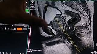 MRI PROSTATE SCANNING INTERPRETATION [upl. by Blackington850]