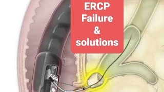 ERCP procedure failures and their solutions [upl. by Haily721]